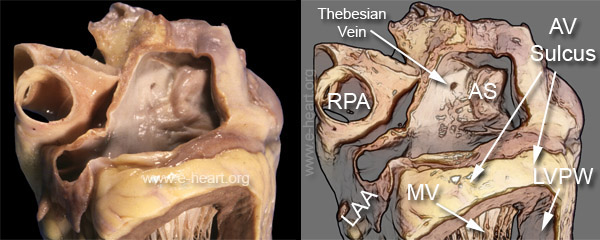 Left Atrium